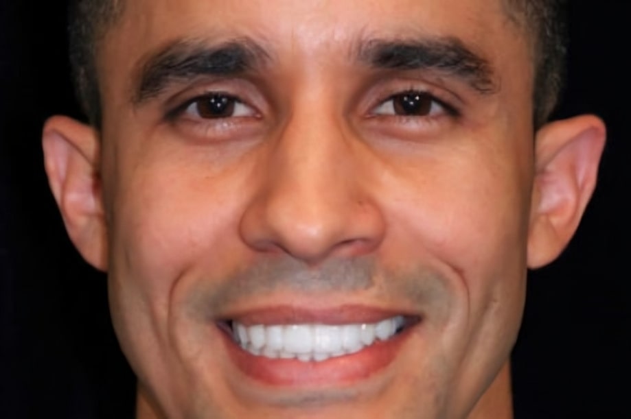 The before and after of the smile of one of our patients at The Cow Boy Dentist