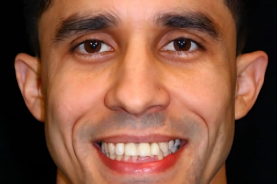 The before and after of the smile of one of our patients at The Cow Boy Dentist