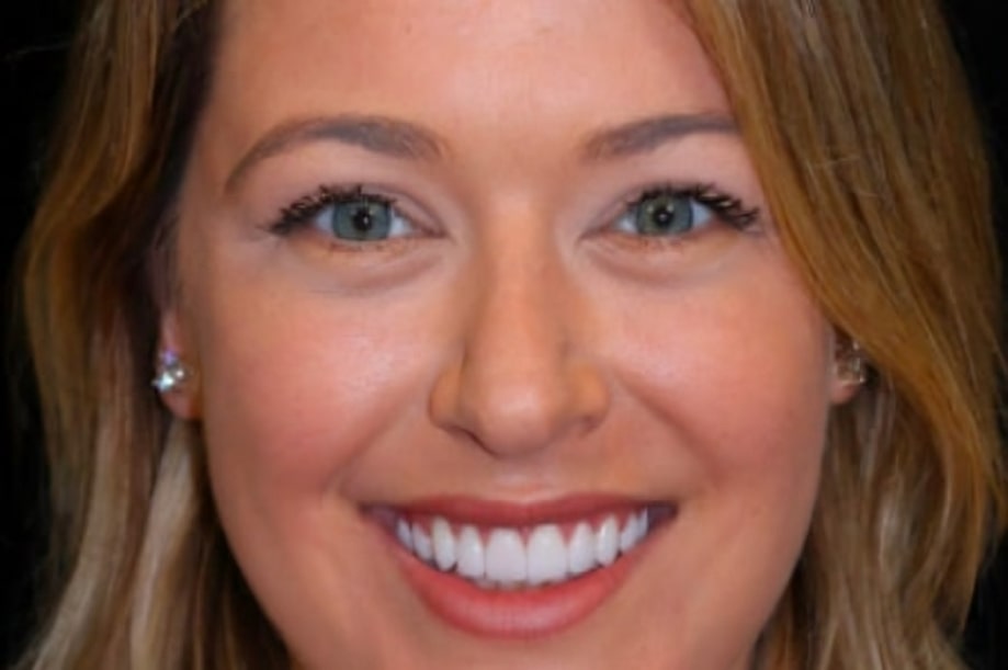 The before and after of the smile of one of our patients at The Cow Boy Dentist