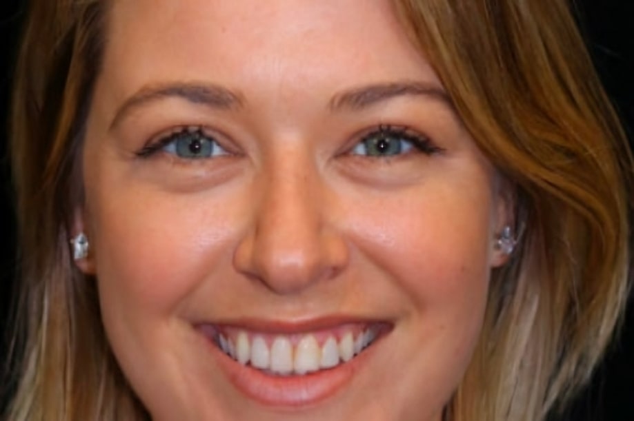 The before and after of the smile of one of our patients at The Cow Boy Dentist