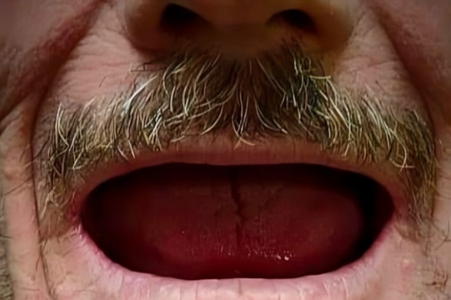 The before and after of the smile of one of our patients at The Cow Boy Dentist