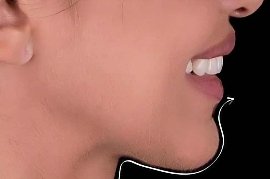 The before and after of the smile of one of our patients at The Cow Boy Dentist