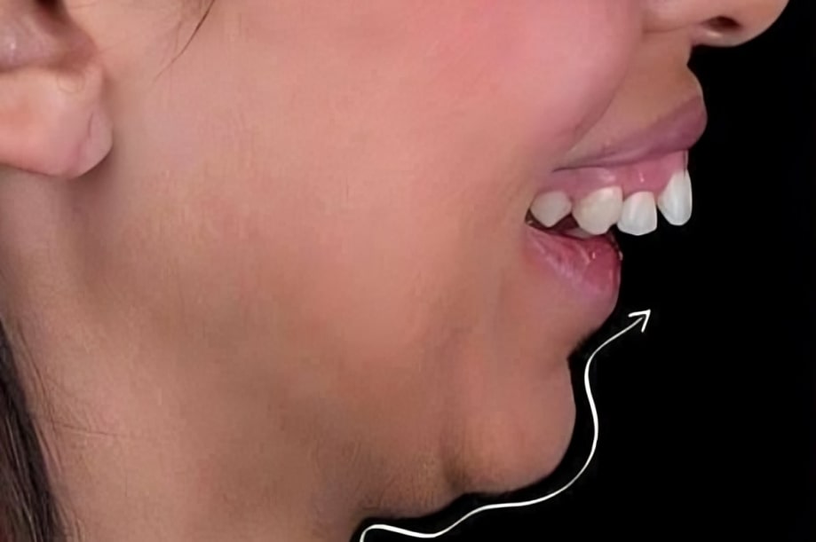 The before and after of the smile of one of our patients at The Cow Boy Dentist