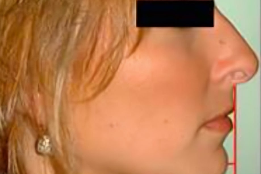 The before and after of the smile of one of our patients at The Cow Boy Dentist