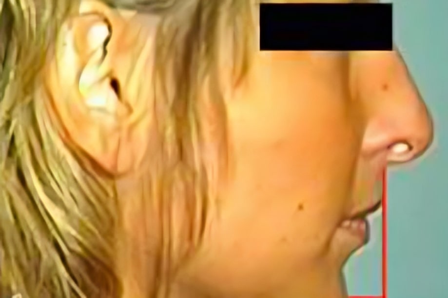 The before and after of the smile of one of our patients at The Cow Boy Dentist