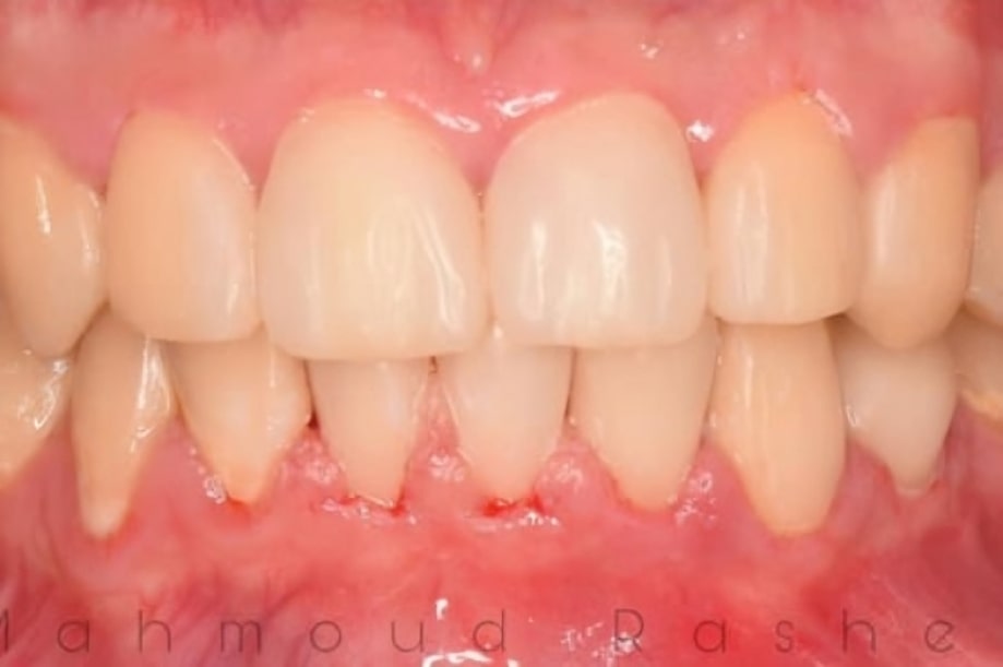 The before and after of the smile of one of our patients at The Cow Boy Dentist