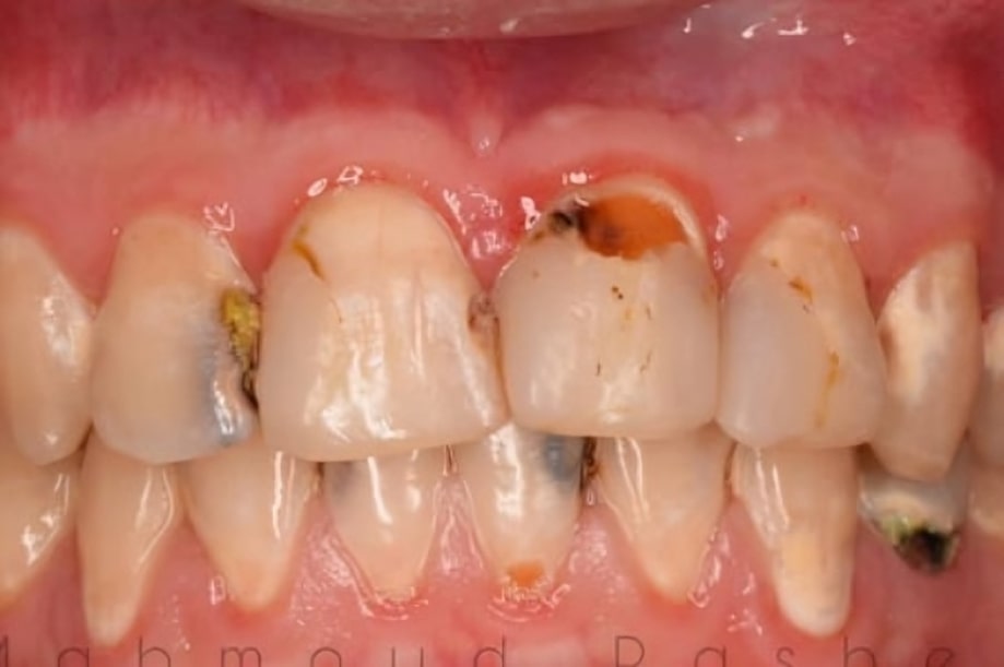 The before and after of the smile of one of our patients at The Cow Boy Dentist