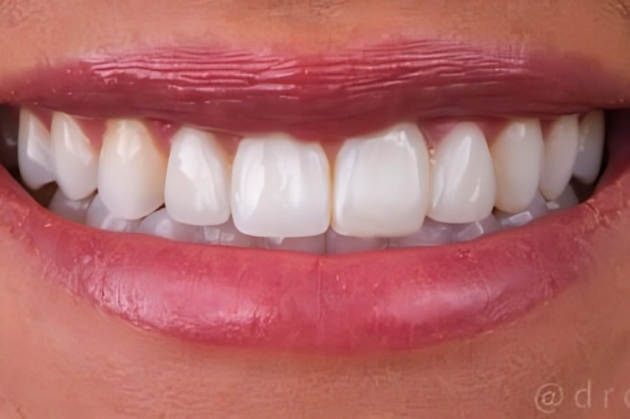 The before and after of the smile of one of our patients at The Cow Boy Dentist