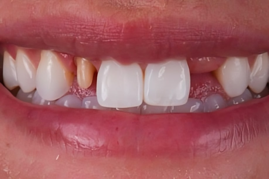 The before and after of the smile of one of our patients at The Cow Boy Dentist