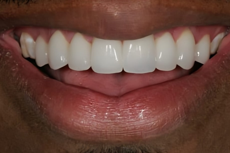 The before and after of the smile of one of our patients at The Cow Boy Dentist