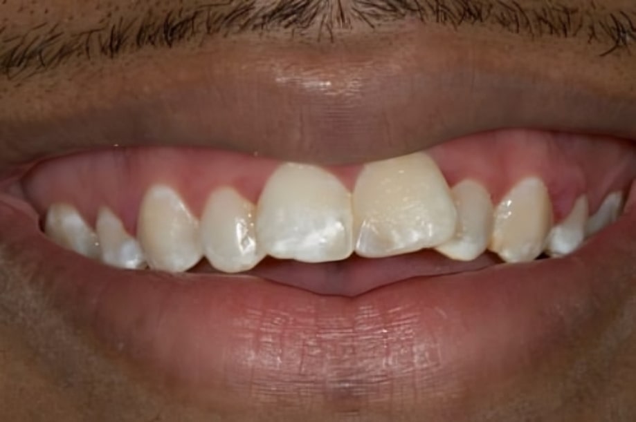 The before and after of the smile of one of our patients at The Cow Boy Dentist