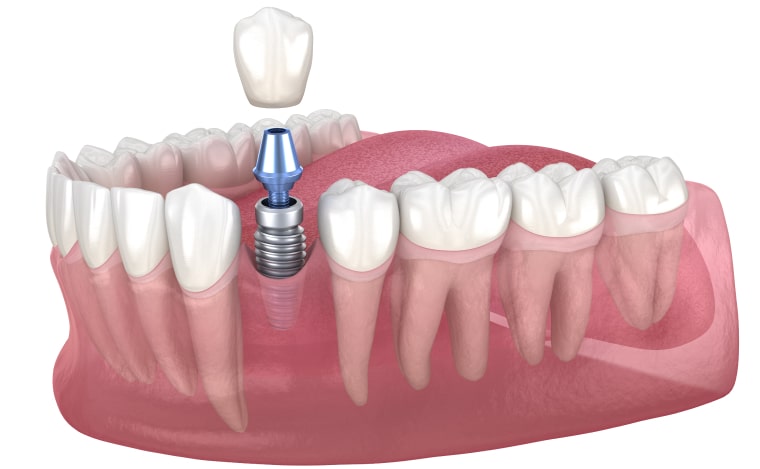 Metal-Free Dental Implants: The Natural Choice For a Beautiful Smile