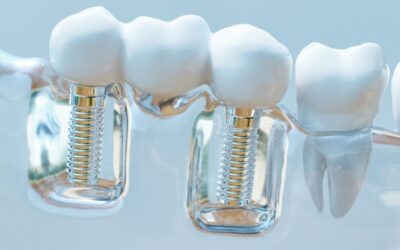 Investing in Your Health: The Long-Term Benefits of Metal-Free Dental Implants