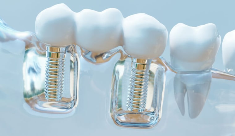 Investing in Your Health: The Long-Term Benefits of Metal-Free Dental Implants