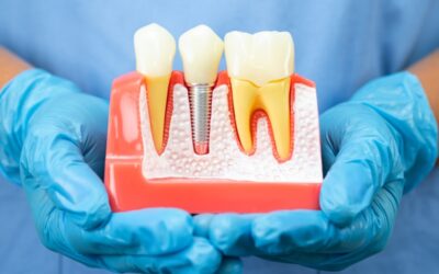 Healing Timeline: A Week-by-Week Guide to Your Implant Recovery