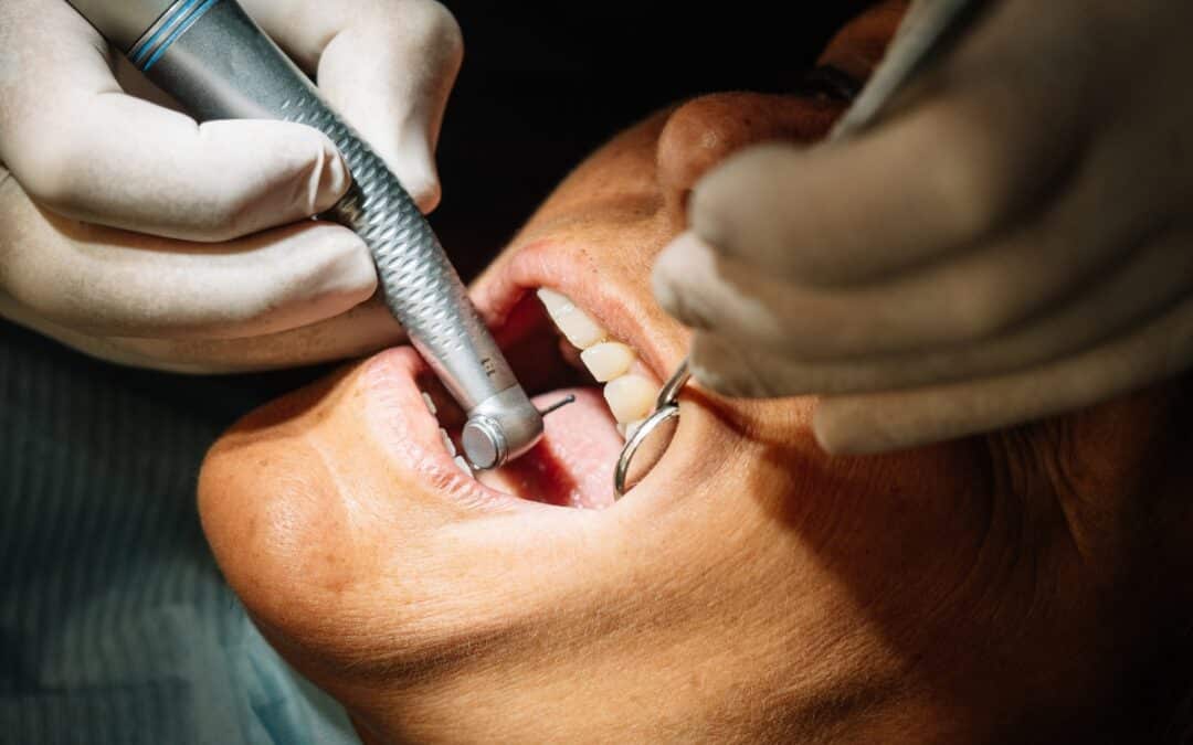 Can All-on-4 Implants Be Done Without Bone Grafting?