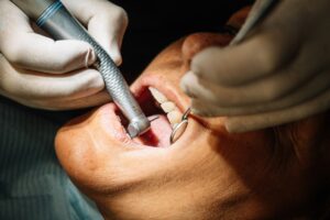 All-on-4-Implants
