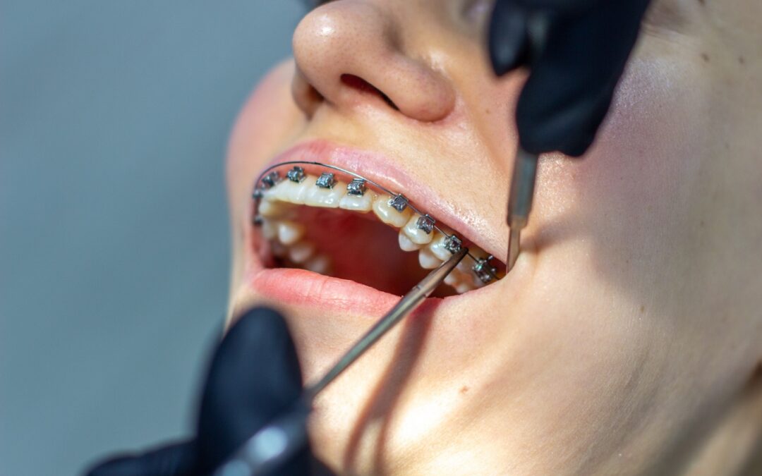 Do Fastbraces Really Work Faster for Patients? A Timeline Comparison