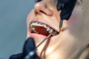 Fastbraces-in-Manvel-Rosenberg