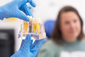 Full-Mouth-Dental-Implants-in-Rosenberg