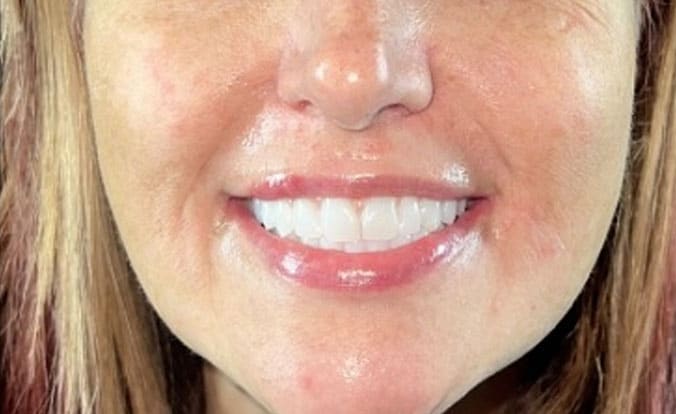 Same patient after dental implant treatment