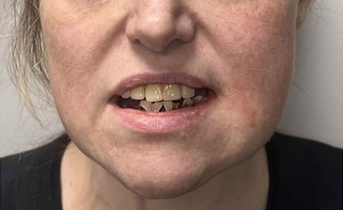 Patient smile before dental implant treatment