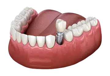 Single tooth dental implant