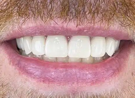 Same patient after implant treatment