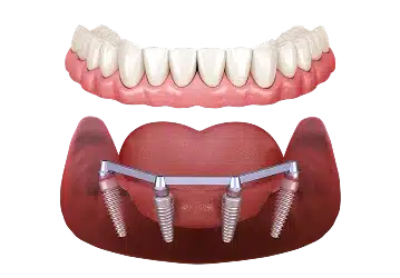 Single-arch fixed All-On-4 dental implants