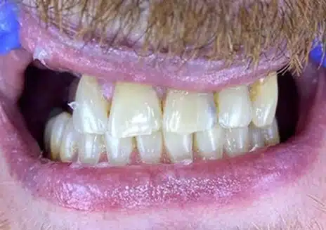 Patient smile before implant treatment