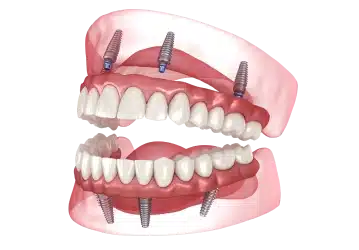 Full-mouth dental implants