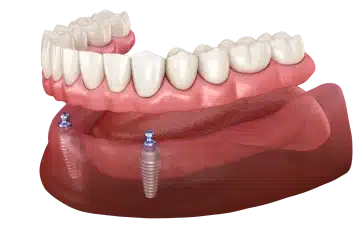Teeth by noon same-day implants
